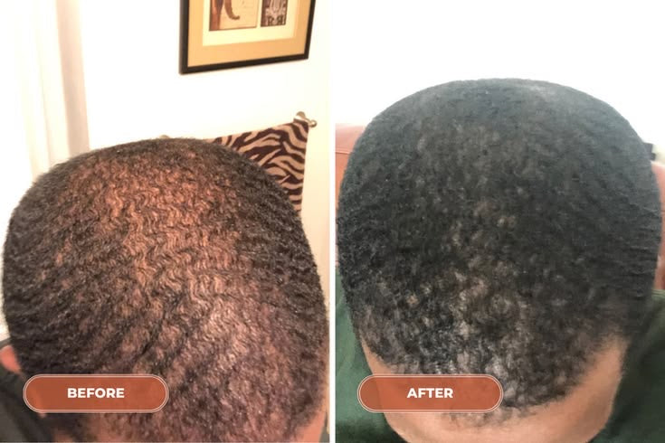 Minoxidil 5% Hair Growth Serum for Men – 6 Month Supply